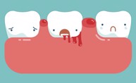 Làm sao để khắc phục tình trạng chảy máu chân răng hiệu quả? Chuyên gia Nguyễn Hồng Hải tư vấn