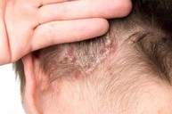 Bị vảy nến da đầu nên điều trị như thế nào và có bôi kem Explaq được không?