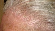 Da đầu bị bong tróc từng mảng có phải dấu hiệu bệnh vảy nến không? Nên điều trị như thế nào?