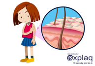 Kim Miễn Khang & Explaq - Hỗ trợ điều trị vảy nến, lupus ban đỏ do tự miễn