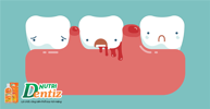 Người hay bị chảy máu chân răng cần xử lý như thế nào? Dùng Nutridentiz có được không?