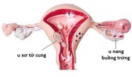Dấu hiệu nhận biết u xơ tử cung và u nang buồng trứng là gì?