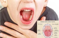 Trẻ bị viêm họng, viêm đường hô hấp trên phải làm sao và phòng ngừa bệnh?