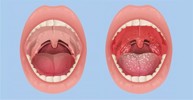 Bị viêm họng mạn tính và có hạch ở cổ họng phải làm sao?