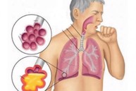 Viêm đường hô hấp trên có lây không? Làm sao để phòng ngừa?
