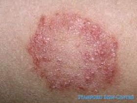 Một số bệnh nấm da thường gặp
