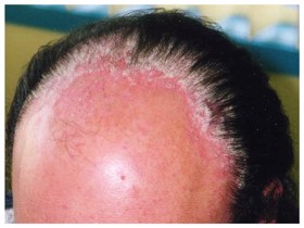 Vẩy nến da đầu: Cần điều trị kiên trì