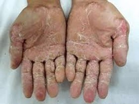 Bệnh á sừng bàn tay, chân và cách chăm sóc da khi mắc bệnh