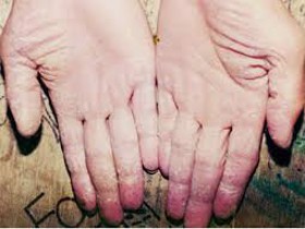 Bệnh á sừng có chữa khỏi được không?