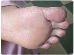 Bàn chân nứt nẻ do bệnh vẩy da