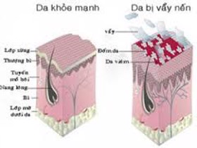 Điều trị bệnh ngoài da có vẩy hiệu quả