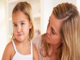Thủy đậu ở trẻ em và những ngộ nhận sai lầm