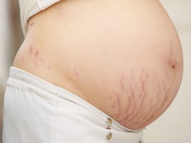 Rạn da khi mang thai: Mối lo lắng của người phụ nữ