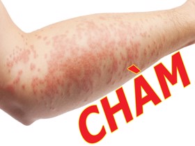 4 nguyên nhân không ngờ khiến bệnh eczema “ghé thăm” bạn