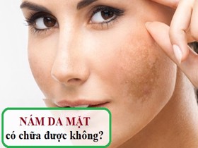 Nám da mặt có chữa được không? – Một số sai lầm trong điều trị nám bạn nên CẬP NHẬT!