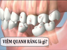 Viêm quanh răng là gì và làm sao để điều trị bệnh được hiệu quả?