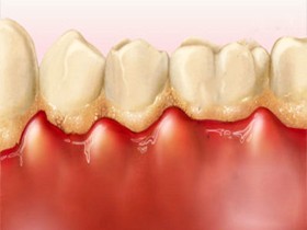 Trị sưng lợi răng bằng cách nào để cải thiện nhanh? TÌM HIỂU NGAY
