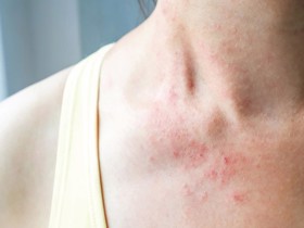 Cách khắc phục bệnh chàm da tại nhà như thế nào? TÌM HIỂU NGAY