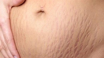 Cách trị rạn da sau sinh hiệu quả chỉ sau 3 tháng: Bí kíp từ thảo dược của chị Kiều – Đồng Nai