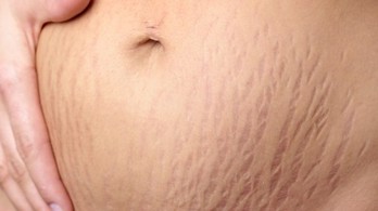 Cải thiện tình trạng rạn da sau sinh hiệu quả sau 3 tháng: Bí kíp của chị Kiều – Đồng Nai