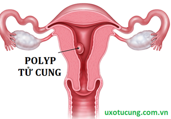 Polyp tử cung là gì? Dùng sản phẩm thảo dược để điều trị có tốt không?