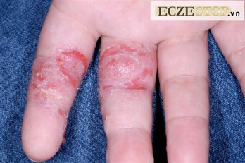 Bị viêm da, mụn nước ở ngón và lòng bàn tay có phải bệnh tổ đỉa không?