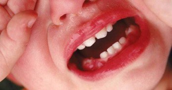 Cải thiện viêm nướu răng ở trẻ em bằng giải pháp từ thiên nhiên hiệu quả