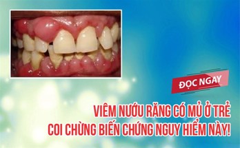 Viêm nướu răng có mủ ở trẻ - COI CHỪNG biến chứng nguy hiểm này! 