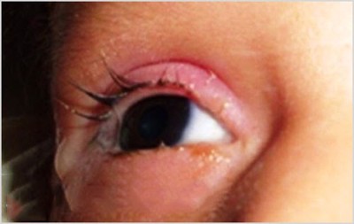 Thủy đậu mọc ở mắt có nguy hiểm không, điều trị như thế nào để không gặp biến chứng?