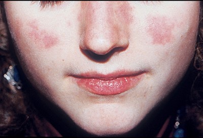 Lupus ban đỏ gây ra nhiều thương tổn
