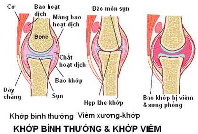 NHỮNG ĐIỀU CẦN BIẾT VỀ BỆNH VIÊM KHỚP DẠNG THẤP