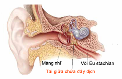 Viêm tai giữa gây suy giảm thính lực