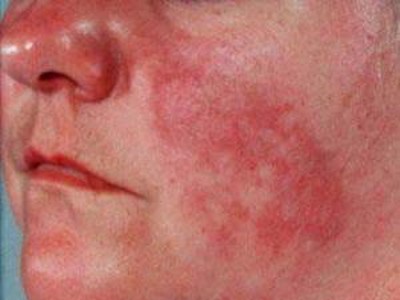 Lupus ban đỏ có phải là bệnh lây truyền không?
