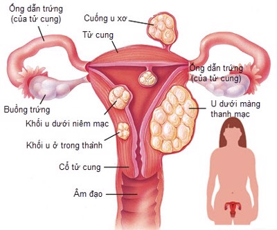 Nga Phụ Khang- Hỗ trợ điều trị u xơ tử cung, u nang buồng trứng