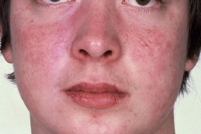 8 triệu chứng lupus ban đỏ điển hình bạn không nên bỏ qua