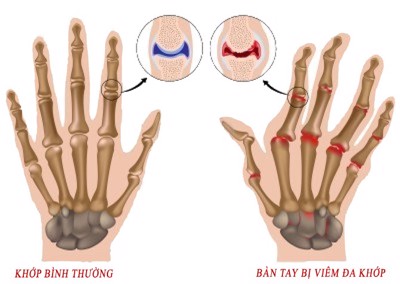 THÔNG TIN Y HỌC VỀ BỆNH VIÊM KHỚP DẠNG THẤP