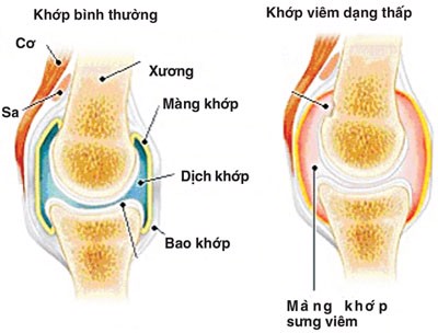 Nguy cơ mắc ung thư khi bị bệnh viêm khớp dạng thấp