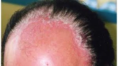 Thông tin về bệnh vẩy nến da đầu