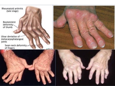 Đau khớp đối xứng- Dấu hiệu nhận biết viêm khớp dạng thấp