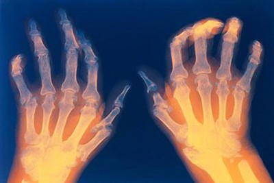 Tác dụng của ánh nắng mặt trời với bệnh viêm khớp