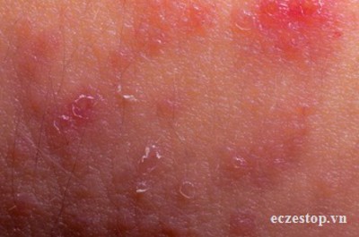 Bệnh eczema tác động lên làn da như thế nào?