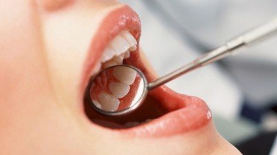 Dấu hiệu của bệnh viêm quanh răng như thế nào?