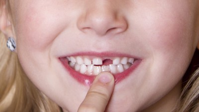 Cảnh báo: 10,7% trẻ em Mỹ bị đau răng!