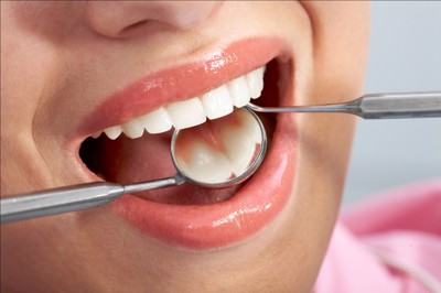  Cách giảm 30-50% tỷ lệ khoan và trám khi bị sâu răng