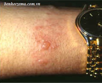 Bạn đã biết những gì về bệnh viêm da tiếp xúc?