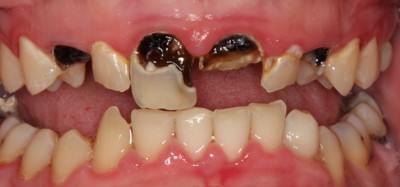 Chớ coi thường 4 lưu ý khi điều trị bệnh sâu răng