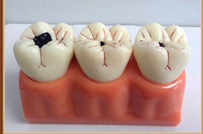 3 triệu chứng bệnh sâu răng bạn nên biết ngay hôm nay!