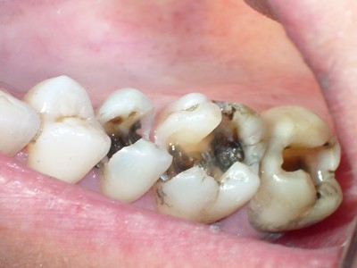 3 nguyên nhân gây bệnh sâu răng, nếu bỏ qua phí 1 đời!