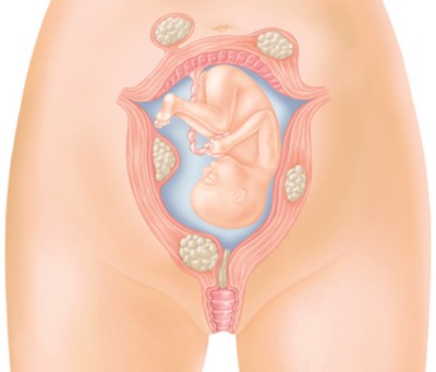 Mắc bệnh u xơ tử cung có nên mang thai hay không?