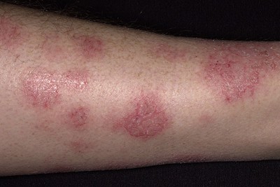 Khi mắc bệnh Eczema nên điều trị như thế nào?